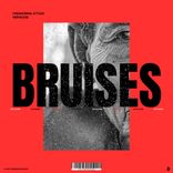 Bruises